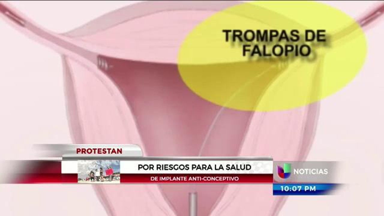 Problemas con Essure