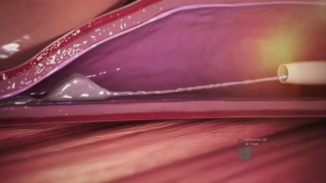 Método innovador para combatir las venas varicosas