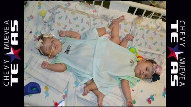 Fueron separadas con éxito las siamesas Ximena y Scarlet