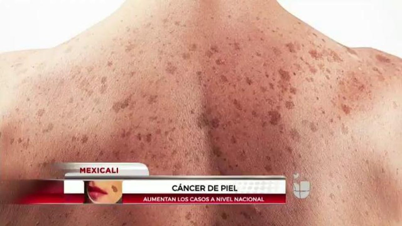 Cáncer de piel.