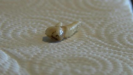 Woman Claims Tooth Found in Food