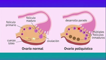 Download Video: bd-sindrome-de-ovario-poliquistico-181121