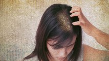 सिर पर तेल लगाने से Dandruff बढ़ता है कि नहीं, Hair Oiling का Dandruff पर खतरनाक Effect | Boldsky
