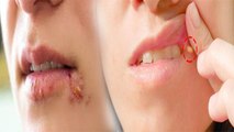 मुंह के किनारे फटने का कारण, Angular Cheilitis के Symptoms नजरअंदाज करना खतरनाक | Boldsky