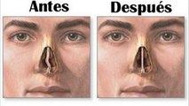 bd-complicaciones-de-tabique-nasal-desviado-251121