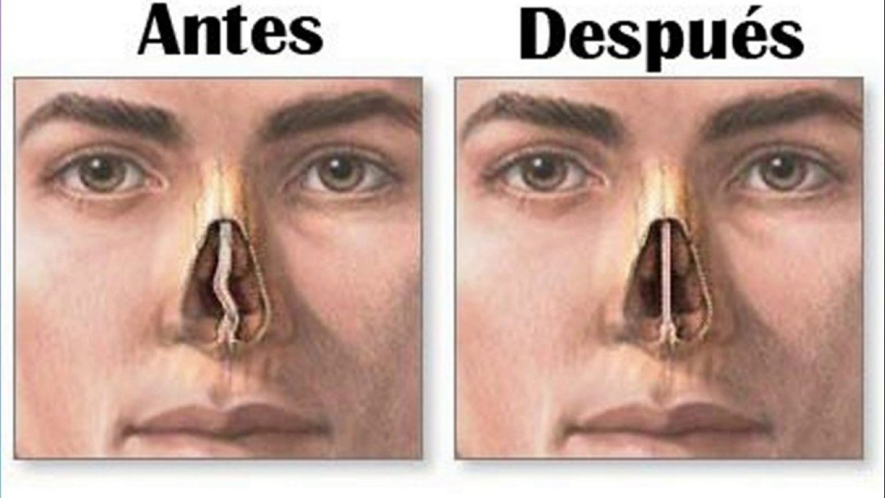 bd-complicaciones-de-tabique-nasal-desviado-251121