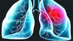 Lungs में Blood Clotting होने पर दिखते हैं ये Symptoms, जानें इसकी वजह | Boldsky