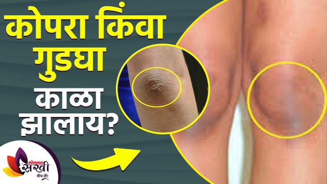 हाताचा कोपरा आणि गुडघ्याच्या त्वचेची कशी घ्याल काळजी | How to get rid of dark elbows and knees |