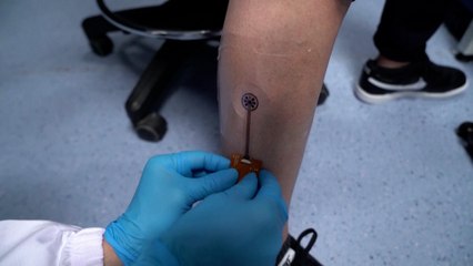 Singapore scientists develop smart bandage that tracks wounds via an app