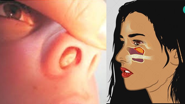 नाक में छाले क्यों होते है । नाक में छाले होना का कारण । नाक के छाले दूर करने का उपाय । Boldsky