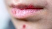 Lips पर दर्द भरे Pimples को आसानी से करें गायब,बस अपना ले ये तरीका । Lips Care Video । Boldsky