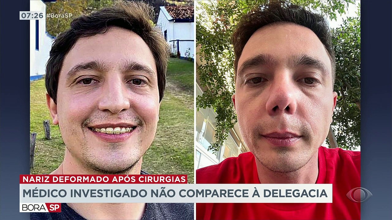 O médico denunciado pelos pacientes que tiveram o nariz deformado não compareceu à delegacia para prestar depoimento. Segundo a polícia, ele só vai dar esclarecimentos após o resultado das perícias.