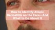 How to Identify Atopic Dermatitis on the Face—And What to Do About It
