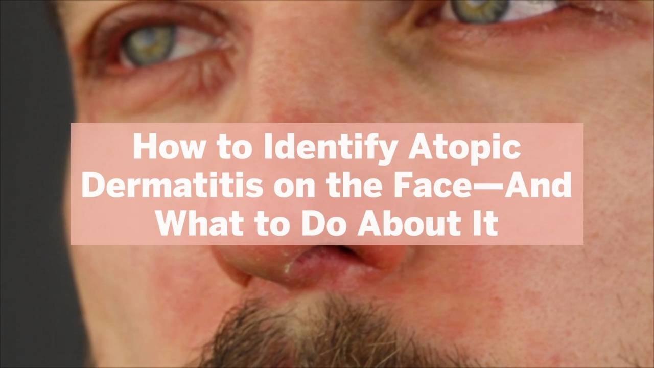 How to Identify Atopic Dermatitis on the Face—And What to Do About It