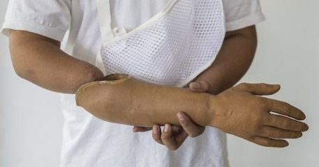 Un anti-vax italien a tenté de se faire vacciner en portant une prothèse de bras, pour obtenir un pass sanitaire