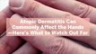 Atopic Dermatitis Can Commonly Affect the Hands—Here's What to Watch Out For