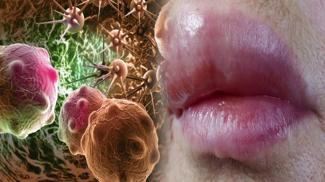 होंठों में अक्सर सूजन रहना है कैंसर के गंभीर लक्षण । जानिए कारण और बचाव के उपाय । Boldsky