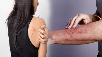 Body पर दिखे 7 Symptoms AIDS का संकेत, कैसे करें बचाव | Boldsky