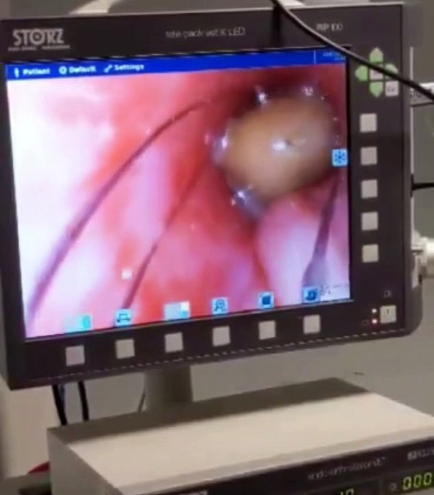 Avonvale - Jetta videoscope