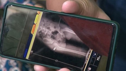 Bocah 7 Tahun Jadi Korban Peluru Nyasar di Gorontalo