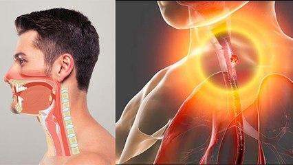 Food Pipe का Infection है बेहद खतरनाक । Expert से  जानें इसके लक्षण और बचाव के उपाय । Boldsky