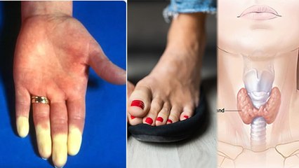 सर्दी में पैर ठंडे होना गंभीर बीमारी का Symptom, Raynaud से Diabetes तक का खतरा | Boldsky