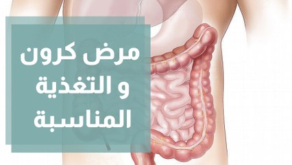 مرض كرون و التغذية المناسبة