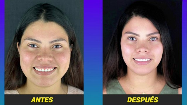 bd-sonrisa-gingival-071221