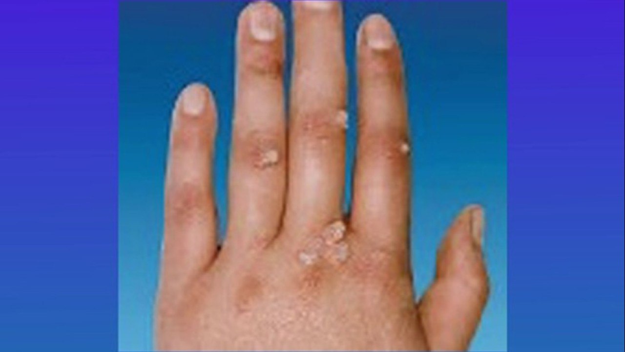 bd-verrugas-mezquinos-y-cabezas-de-vena-causas-y-tratamientos-081221