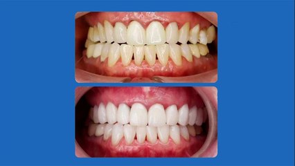 bd-cambios-de-color-en-los-dientes-que-significan-101221