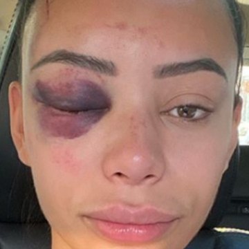 VOICI-SOCIAL Yasmine (Les princes et princesses de l'amour) : agressée et défigurée, son témoignage glaçant (1)