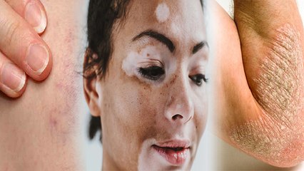 Vitamins की कमी Skin Problems का कारण, Ageing से लेकर Vitiligo तक का खतरा | Boldsky