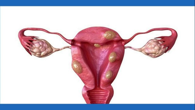 bd-miomas-uterinos-cuando-debe-preocuparse-161221