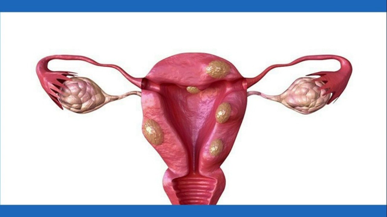 bd-miomas-uterinos-cuando-debe-preocuparse-161221