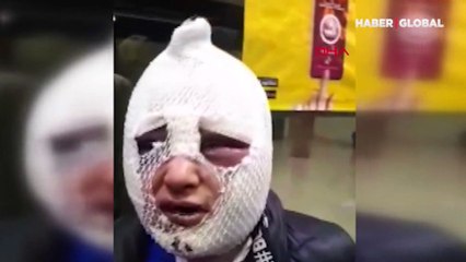 Vahşetin böylesi! Eski sözlüsünü dövdü, cinsel saldırıda bulunup kızgın yağ döktü