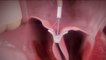Santé - Cardiologie : une pince pout traiter les valves