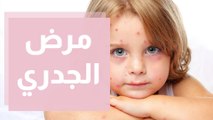 مرض الجدري.. أسبابه وأعراضه وطرق الوقاية