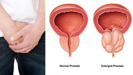प्रोस्टेट बढ़ने के कारण | प्रोस्टेट बढ़ने पर क्या करना चाहिए | Prostate Badhne Ke karan | Boldsky