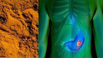 पेट कैंसर का जबरदस्त इलाज, हल्दी मसाला से मिलेगा फायदा | Boldsky