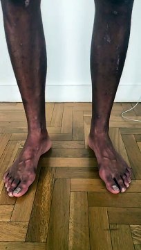 Laurent Maistret partage sa silhouette après le tournage de Koh-Lanta, La Légende . Il a bien morflé !