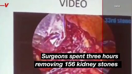 Doctors in India Remove Record Breaking 156 Kidney Stones From One Patient