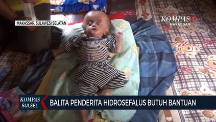 Bayi 1 Tahun Derita Hidrosefalus Tak Dapat Bantuan Pemerintah
