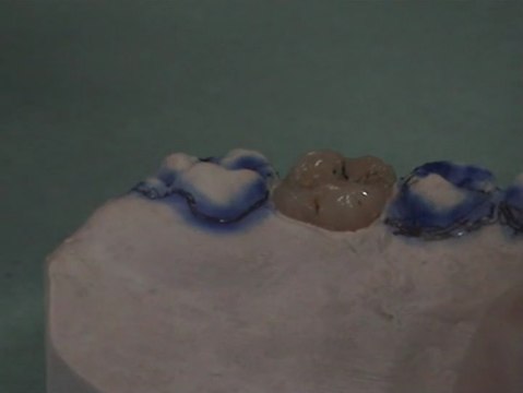 Dentist and cavities