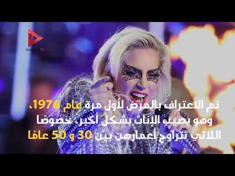 معلومات لا تعرفها عن مرض ليدى جاجا الفيبروميالجيا