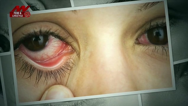 8 home remedies to reduce puffy eyes