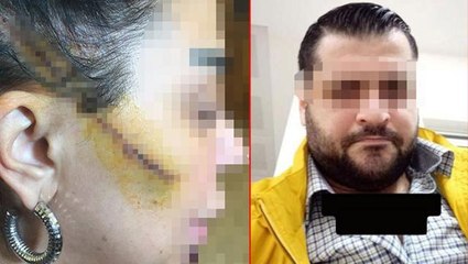 Eski sevgilisinin yüzünü usturayla kesti! Yakalanınca yaptığı paylaşım dikkat çekti: Herkese elveda yakalandım