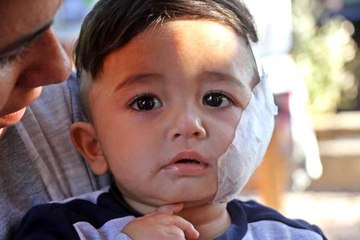 11 aylıkken pitbull saldırısına uğrayan minik Sadrettin, anne kelimesinden önce 'acıyor'u öğrendi