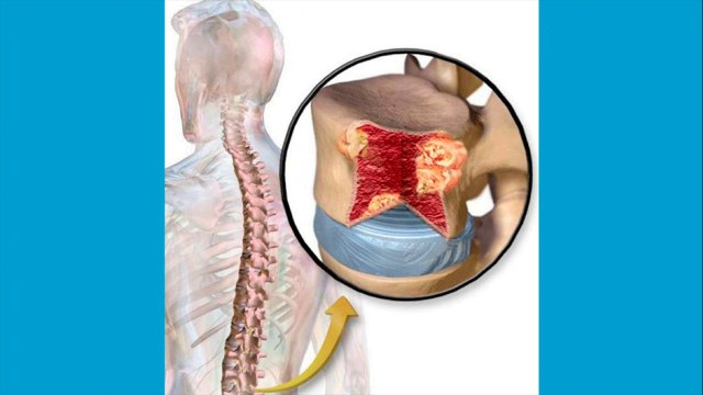 bd-dolor-lumbar-que-puede-llegar-mas-alla-de-un-desgaste-271221