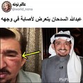 عبدالله السدحان يتعرض لإصابة بالغة خلال التصوير ويطمئن جمهوره بفيديو