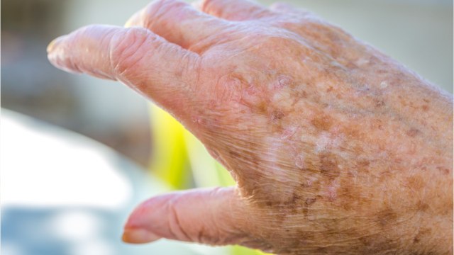 FEMME ACTUELLE - 5 remèdes naturels contre les taches brunes